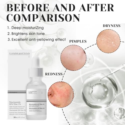 51puvl9m94l.jpg Allony Niacinamide Serum 10%+Zinc 1%, Haut Poren Verfeinern, Pigmentflecken Entfernen, Reduziert Mattheit, Für Alle Haut