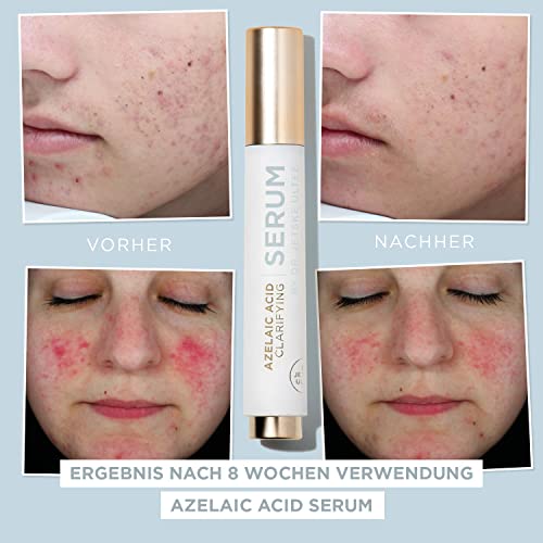 51xe ivdzll.jpg Dr. Jetske Ultee Azelaic Acid Serum - Gegen Rötungen, anti Pickel und Knötchen - Unreine Haut Gesicht - Für sensible Hau